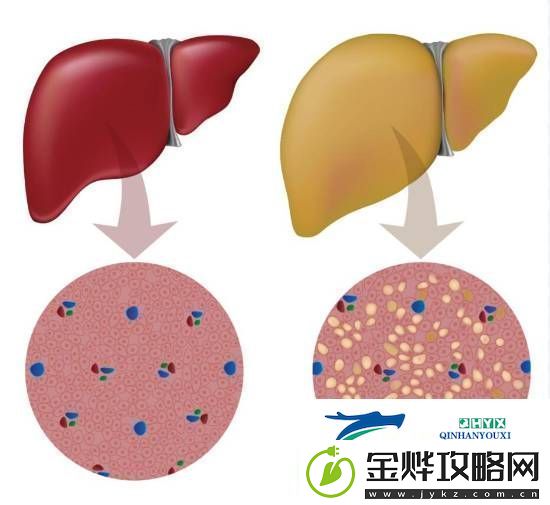 大学生月瘦20斤却患上脂肪肝